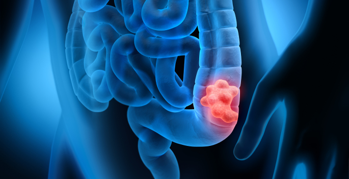 colorectal cancer