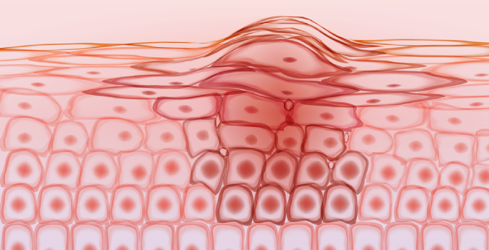 melanoma cell skin cancer