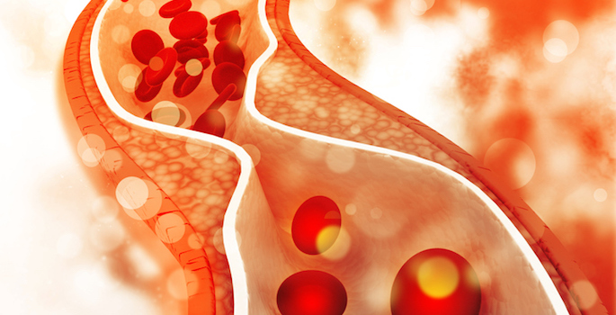 illustration of narrowing in artery showing reduced blood flow