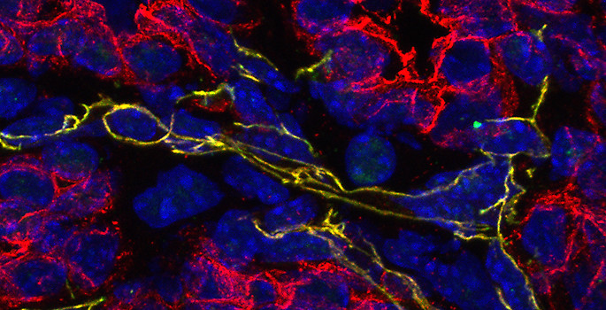 color-enhanced cross section of tumor tissue