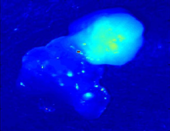 Infrared fluorescence of human parathyroid and thyroid tissue. The fluorescence of the parathyroid tissue on the upper right is twice as strong as that of thyroid tissue, providing an immediate way to differentiate the two. (Mehadevan-Jansen Lab)