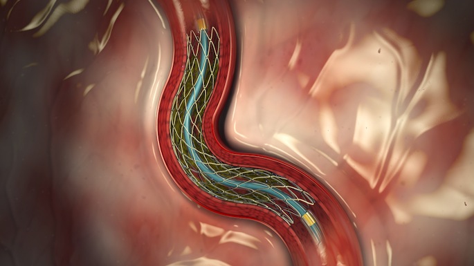 Stent in artery