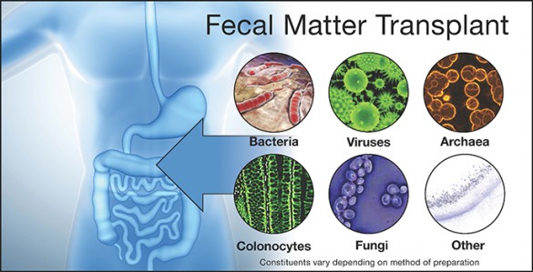 diagram of fecal transplant components