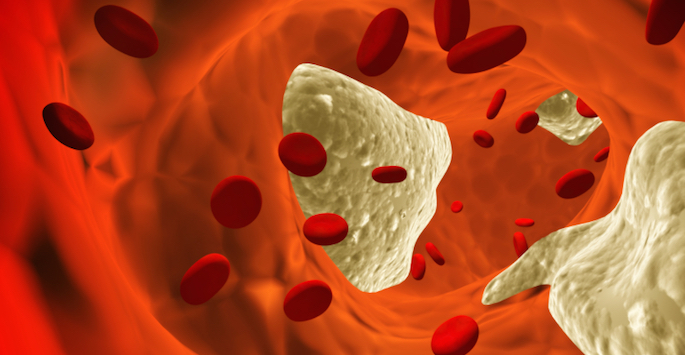illustration of cholesterol blockage