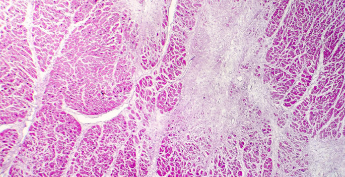 Acute myocardial infarction, heart tissue