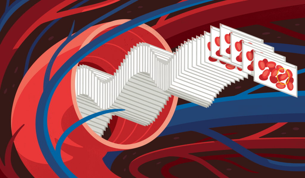 Rare disease treatment with AI