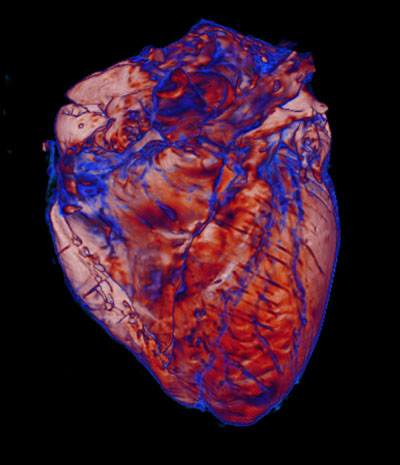 This is a 3D volume rendering of an MRI of a post-mortem heart obtained from a patient with COVID-19, acquired at ultra-high 500 micron spatial resolution.