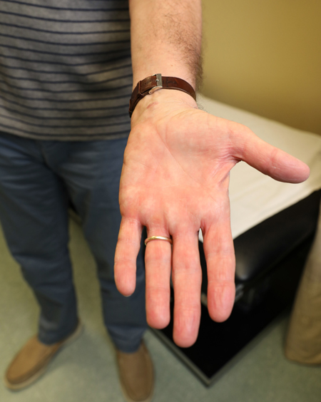 Patient Tommy Rainey is regaining function in his hand more quickly thanks to his recent carpal tunnel release surgery