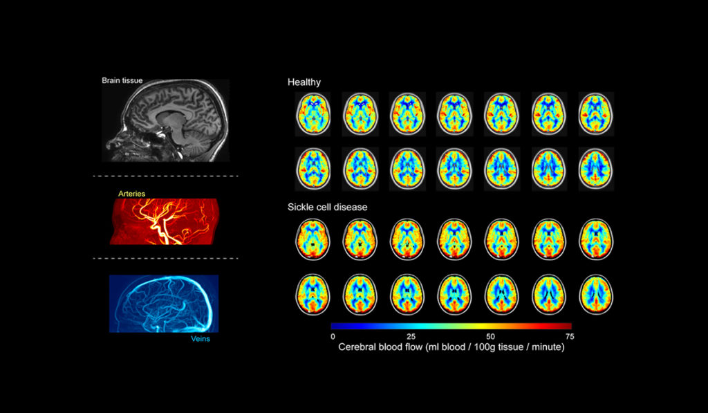 MRI machine reading oxygen levels in patients with and without sickle cell disease.