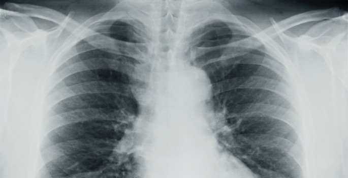 X-ray of lungs