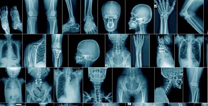 high quality x-ray collection body part and fracture area