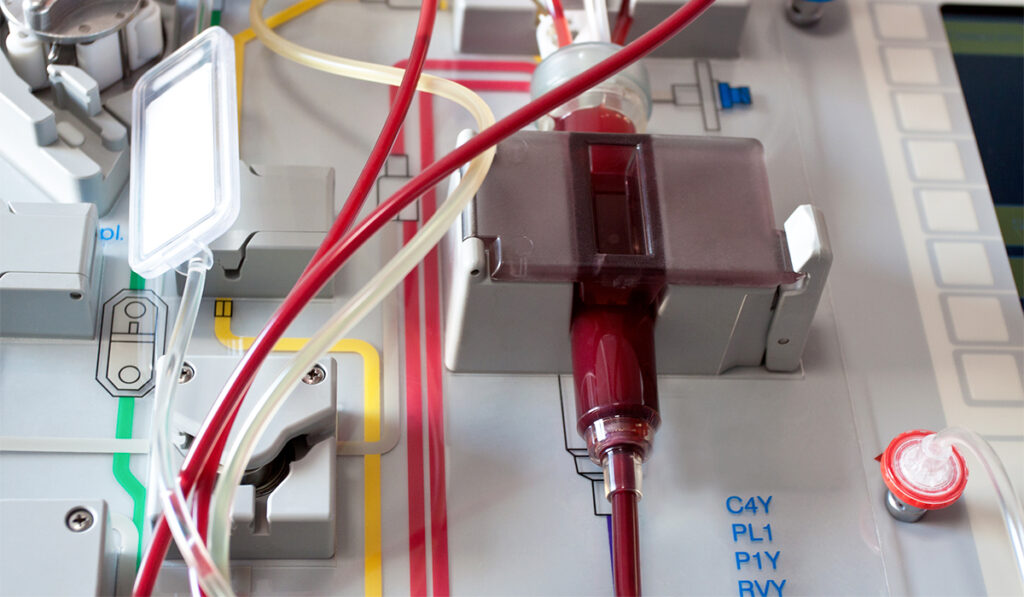 Stem cell transplant