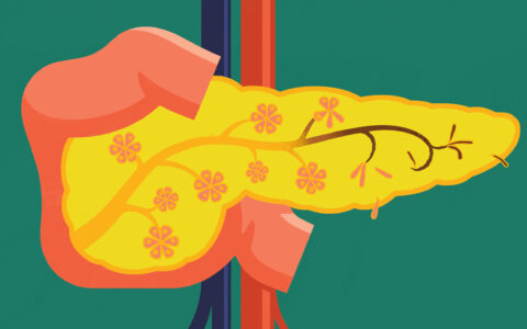 Illustration of pancreatic duct and exocrine cells portrayed as the wilting blossoms of a tree.