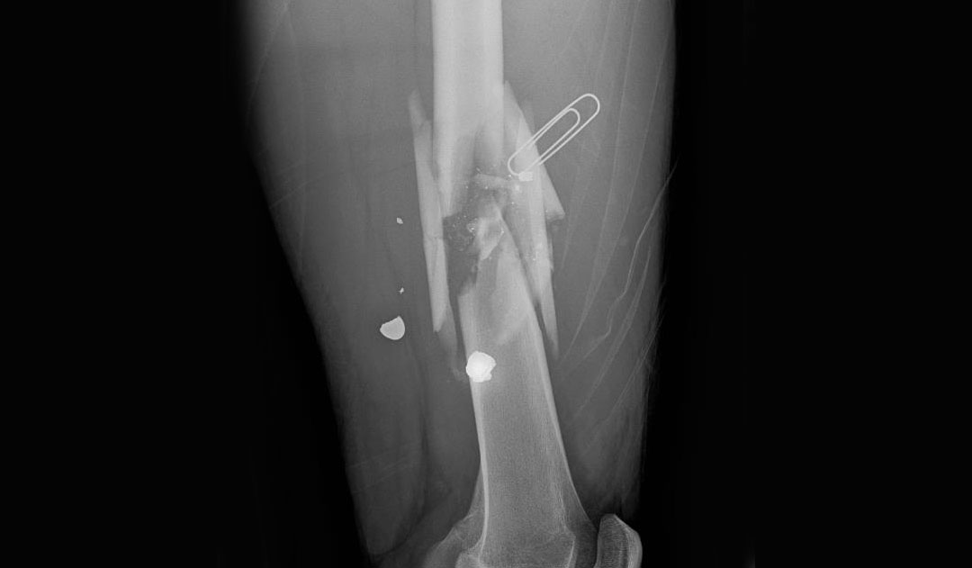 Massive Hospital Costs of Gun Violence