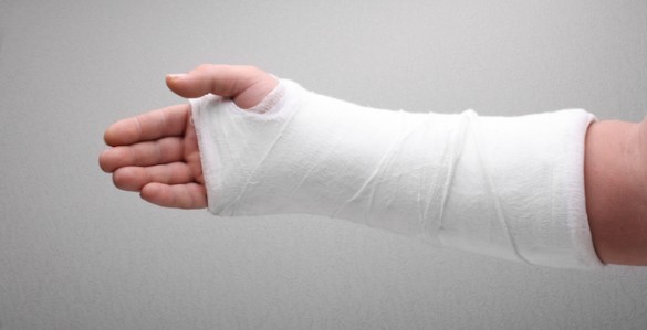 broken arm bone in cast broken arm in cast