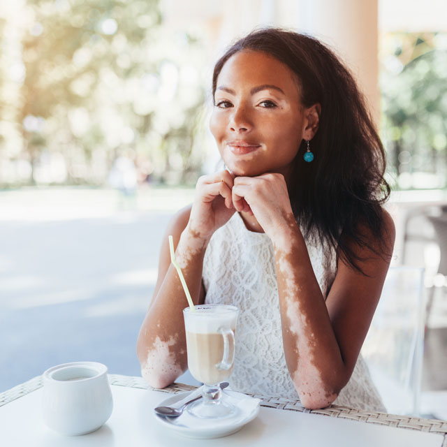 African American woman with vitiligo on face and forearms sits at a cafe table.
