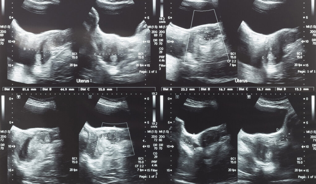 Ultra sound of the uterine