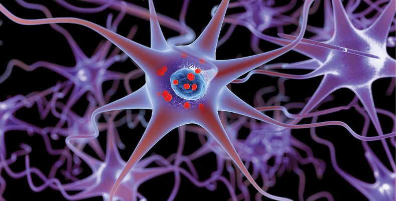 Parkinson’s disease is illustrated in this 3D image showing accumulation of protein deposits, as represented by small red spheres, in brain cells. (Lars Neumann/istock)
