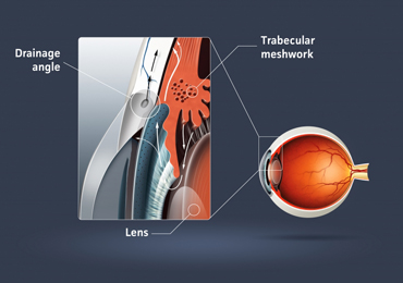 Illustration of glaucoma