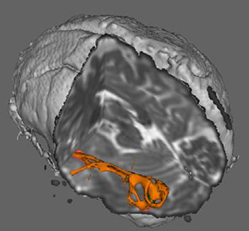 brain-thalamus Brain activity in the thalamus (Vanderbilt)