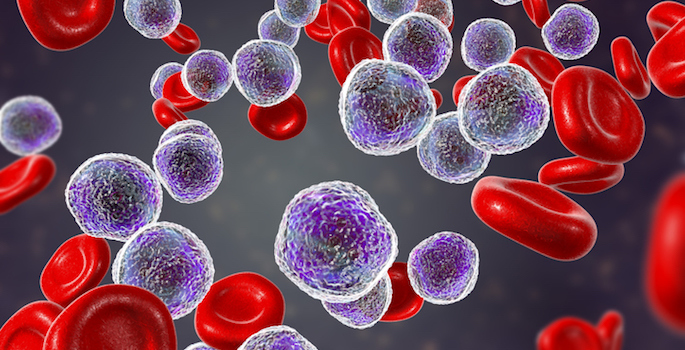 Illustration: Acute lymphoblastic leukemia