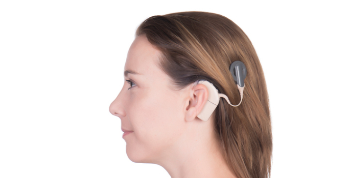 cochlear-implant