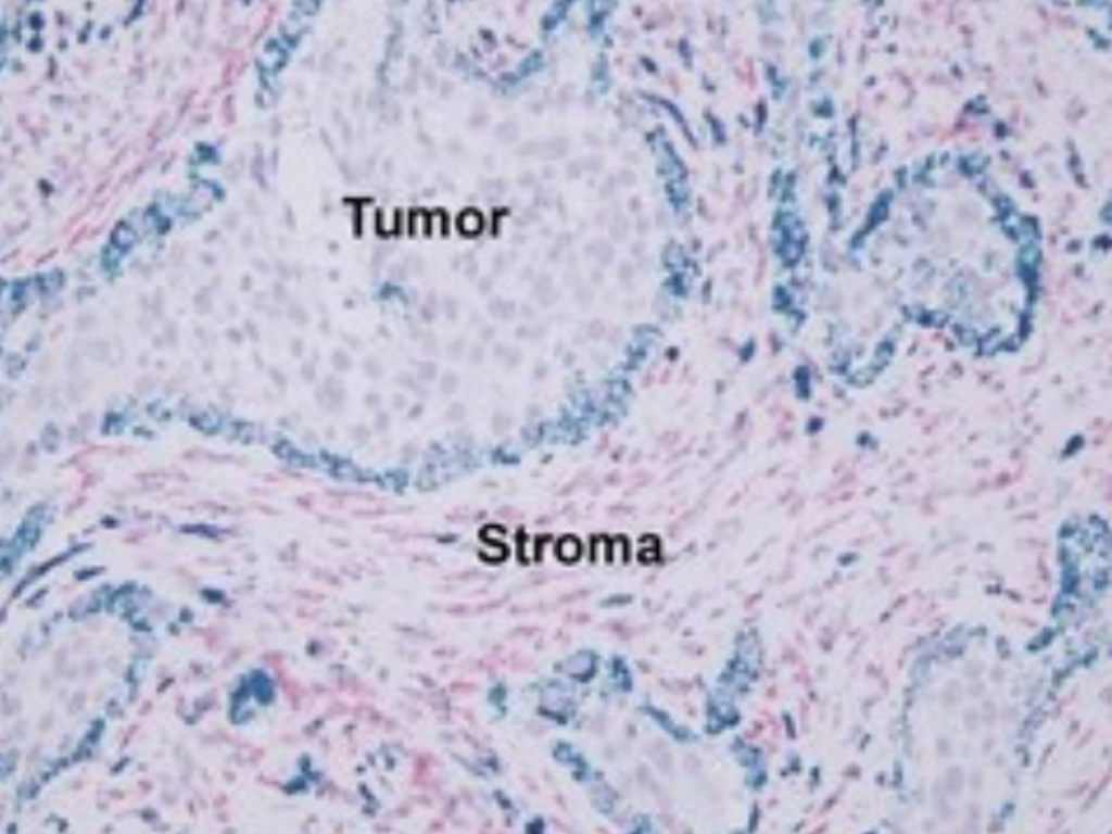 RNAscope of representative anaplastic thyroid cancer samples showing staining for TNC or fibroblast-activating protein. Credit: Hartmann, H. A. et al. (2025). Tenascin-C promotes tumor progression in anaplastic thyroid carcinoma via Wnt activation. Endocrinology, 166(4), Article bqaf030. https://doi.org/10.1210/endocr/bqaf030