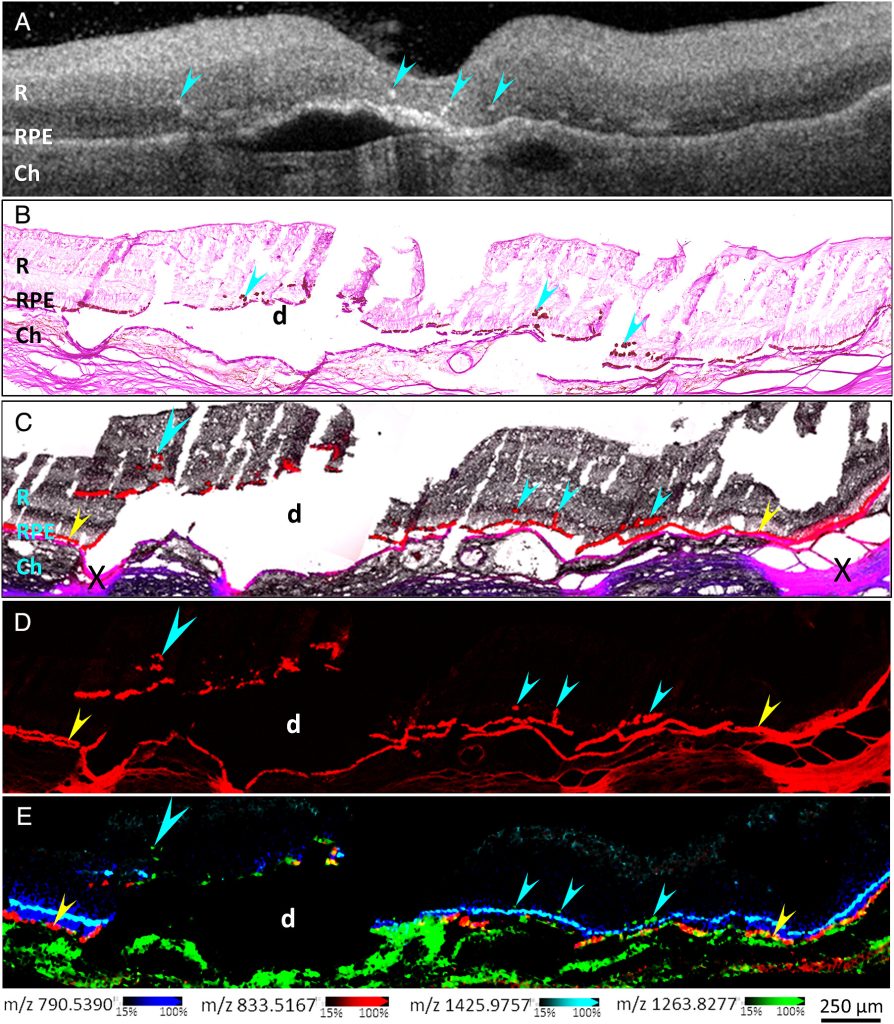 Figure 1 from the paper, which shows five landscape-orientation images stacked on top of one another. Panel A is a black-and-white scan that shows bright points identified by cyan arrows. Panel B is a bright-field image (tissue is stained pink on a white background) and cyan arrows point to hyperreflective foci. Panels C–E show the same location but highlight different aspects. C is imaged in brightfield (black with some colors highlighted over white background), D is a scan for autofluorescence (red over a black background), and E is an IMS analysis (red, blue, yellow, green over a black background, all creating an overlay of four lipids that are located in different parts of the eye). Collectively, panels C–E show RPE cells in the RPE layer (yellow arrows) or RPE cells that migrated (cyan arrows).