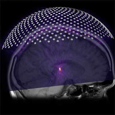 An array of ultrasound transducers covering the head focuses an ultrasound beam to a location deep in the brain associated with pain perception (bright spot). (illustration by Thomas Manuel, PhD)