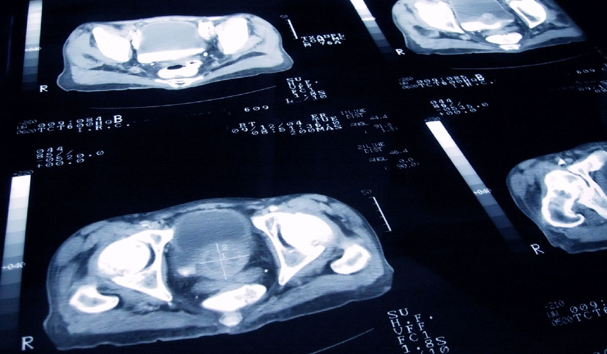 Comparing Patient-Reported Outcomes for Treating Localized Prostate Cancer