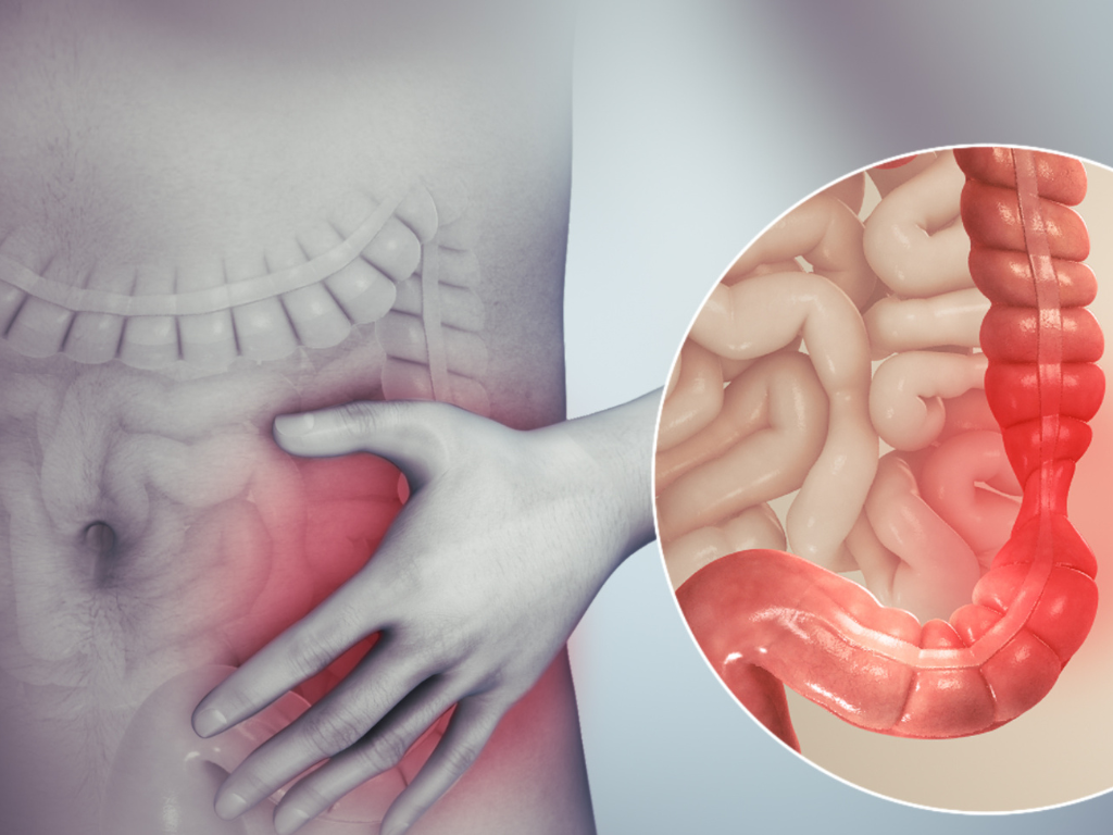 Graphic of irritable bowel syndrome patient