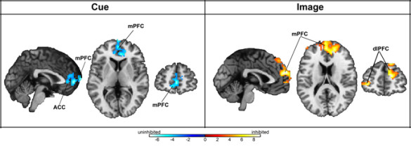 Vanderbilt investigators found that inhibited children had too little prefrontal cortex activation (shown in blue at left) when they saw a cue that predicted seeing a face showing a fearful expression, and too much prefrontal cortex activation when actually viewing the face (shown in orange at right).