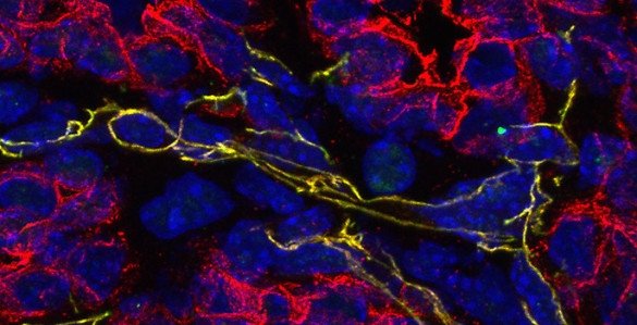 color-enhanced cross section of tumor tissue