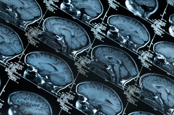 MRI_iStock