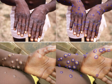 The method uses an algorithm to identify day-to-day change in the number of lesions, which could be used to help assess patient responses in drug trials.