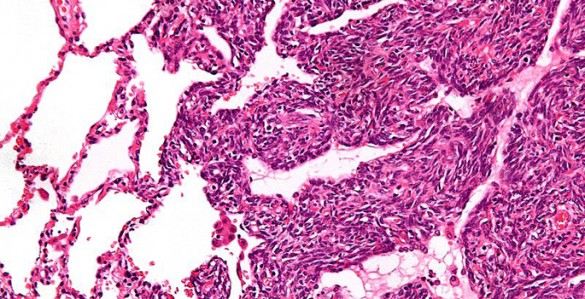 synovial_sarcoma_wiki