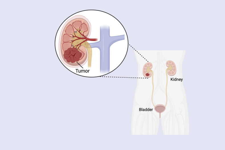 Clear cell renal cell carcinomas form in the tubules that filter waste from the blood. (illustration by Melissa Wolf, PhD)