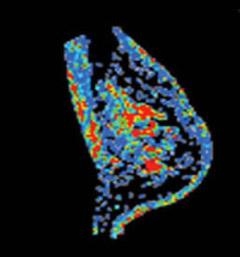 Single-slice image taken from the center of the 3-D volume renderings before and after treatment. (Courtesy of Tom Yankeelov)