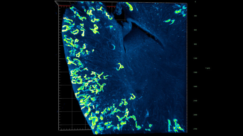 Three-dimensional imaging of kidney tubules (yellow and green noodle-like structures) under low potassium conditions, which puts the kidney into a state of metabolic overdrive and causes cardiovascular problems.