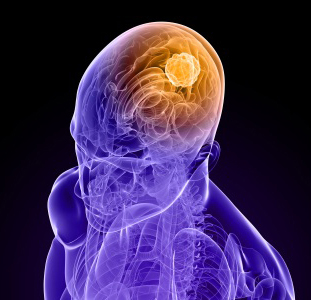 brain tumor_iStock