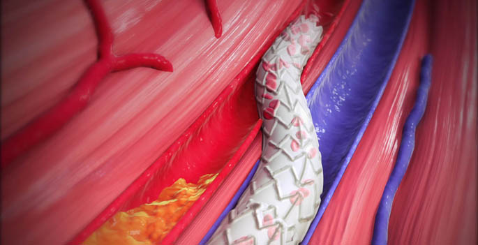 The system is designed to bypass blocked arteries in the leg and restore blood flow into the foot through the veins.