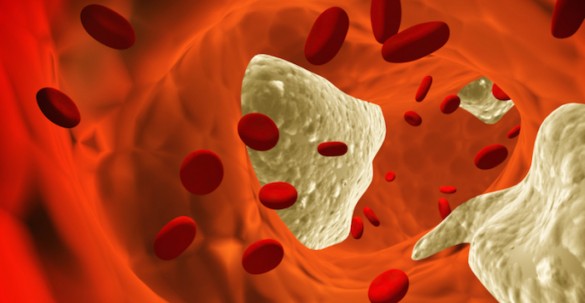 illustration of cholesterol blockage