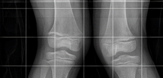 X ray image of bones from the thigh, knee, and feet are white and gray against a black background. The knees are bent inward.