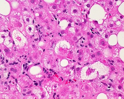 A microscopic image of liver tissue, colored pink, affected by non-alcoholic fatty liver disease (NAFLD), showing large fat droplets, colored white, filling the liver cells