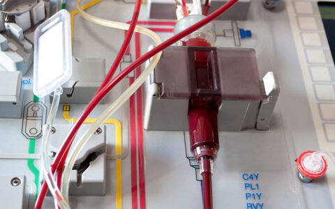 Stem cell transplant