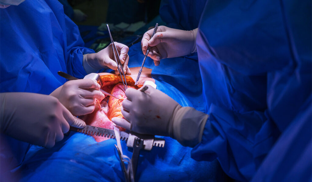 Surgery team performing heart transplant