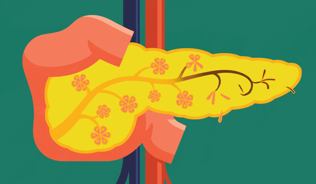 Illustration of pancreatic duct and exocrine cells portrayed as the wilting blossoms of a tree.