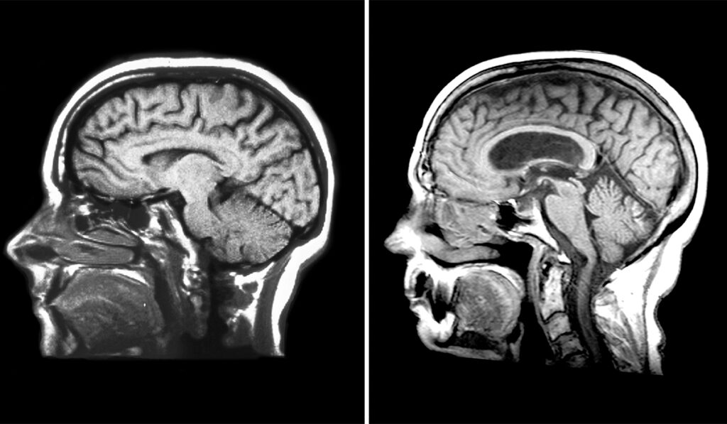 MRI of a normal vs. hydrocephalic brain