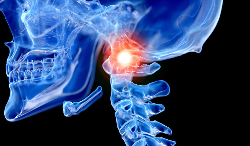 Artistic illustration of a skull and spine, with a bright red spot at the base of the skull where it attaches to the spine