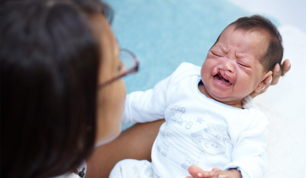 Baby with cleft palate and cleft lip